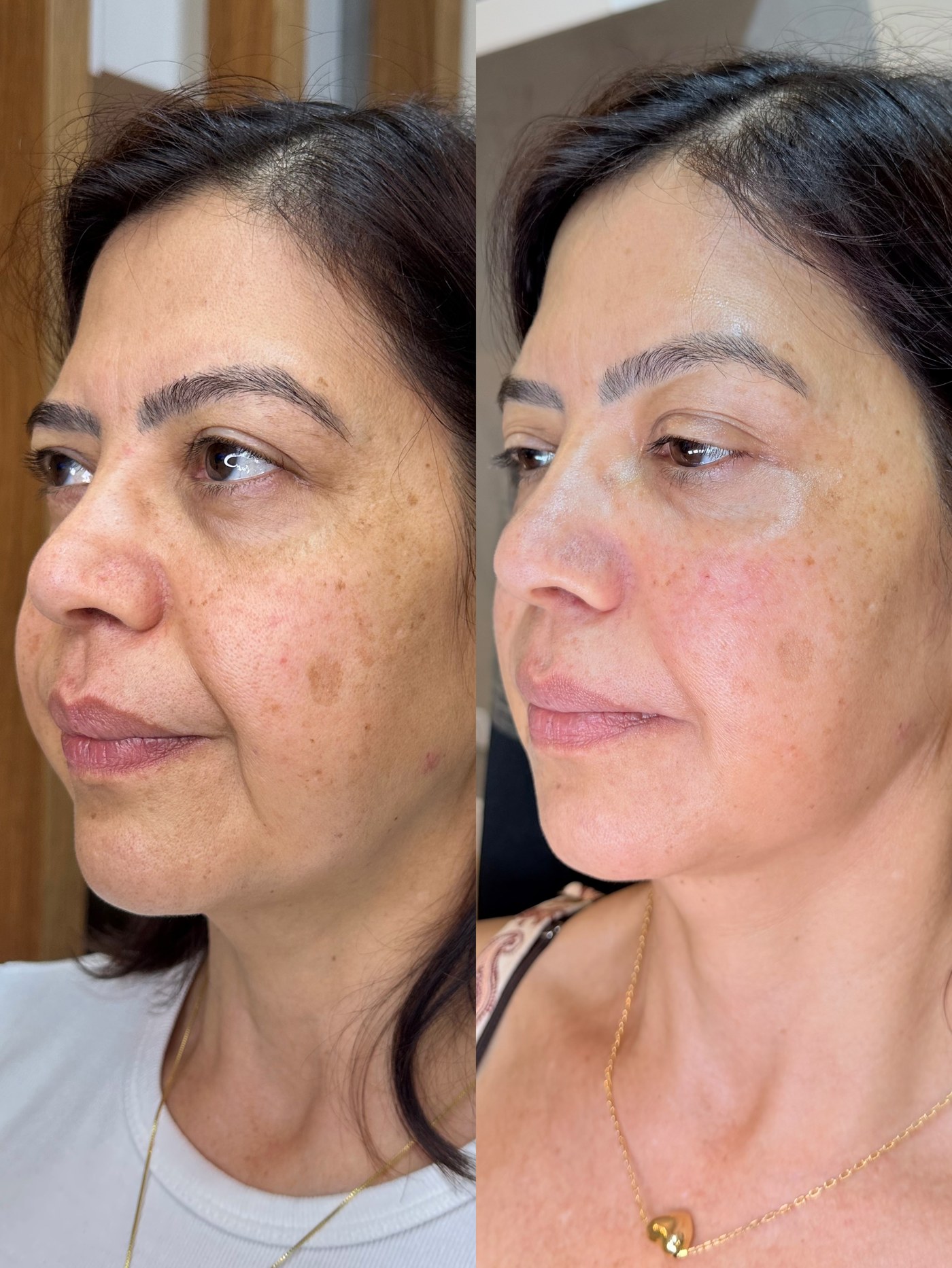 Evolução HarmonyLift — Sustentação Natural