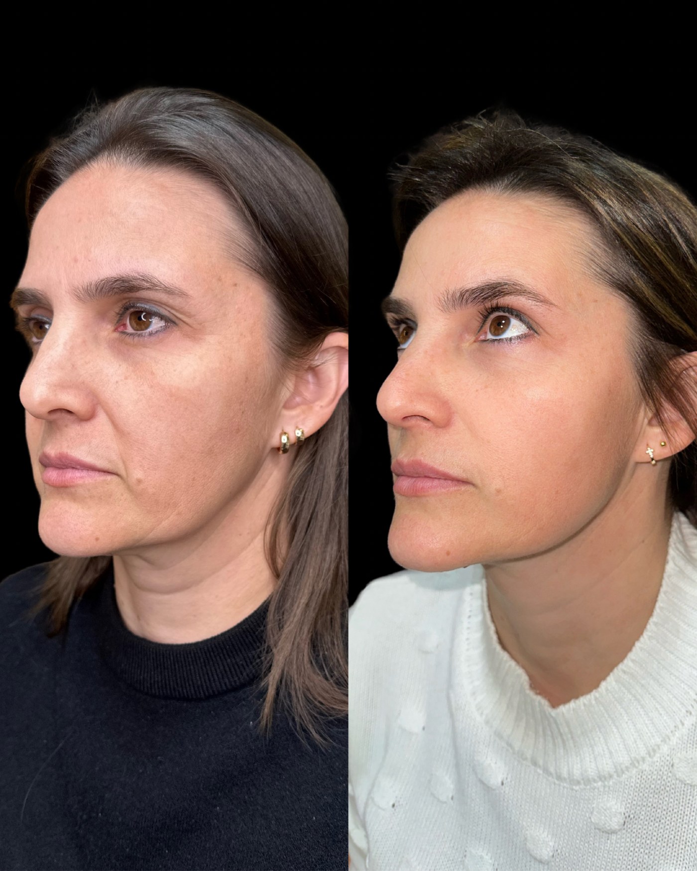 Evolução HarmonySkin — Regeneração Cutânea