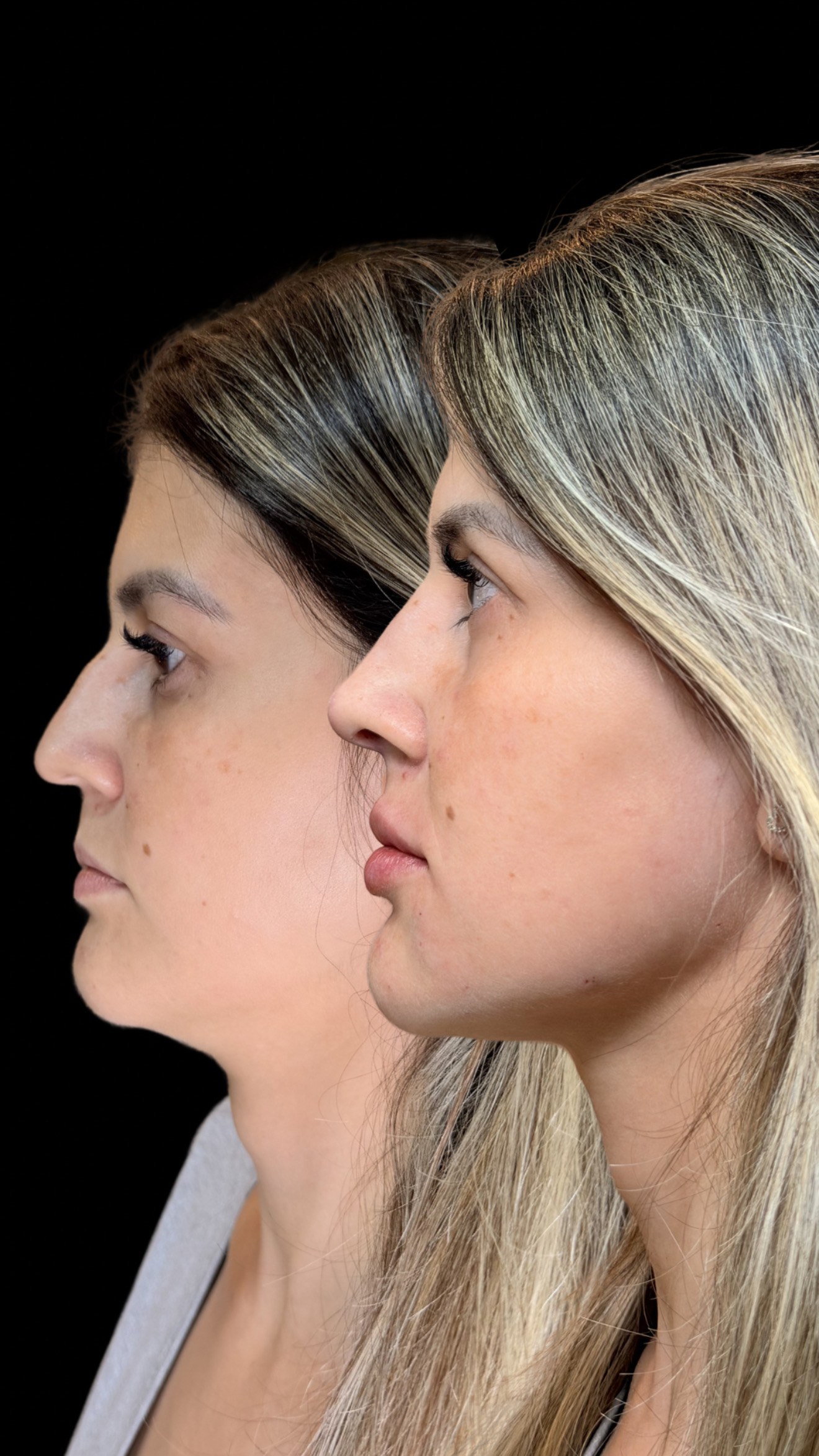 Resultado Shaping Technique — Definição e Contorno Facial